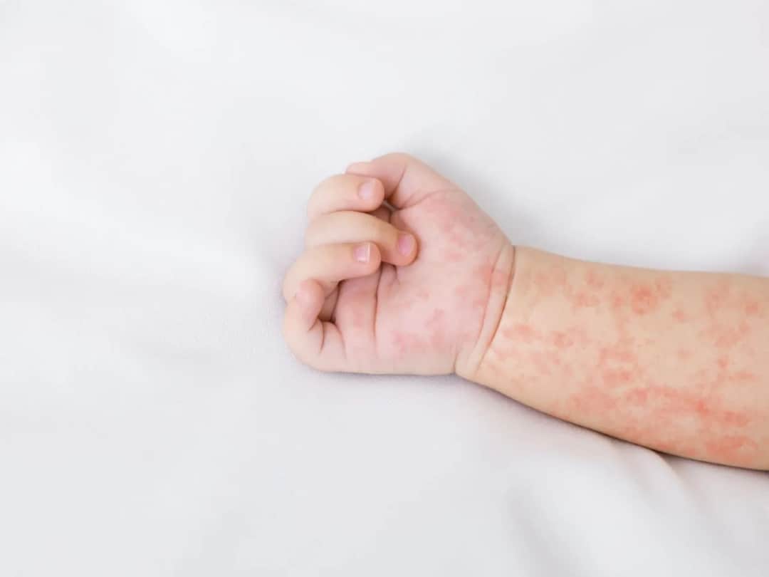 Jak wygląda uczulenie na proszek u niemowlaka? Objawy i rady