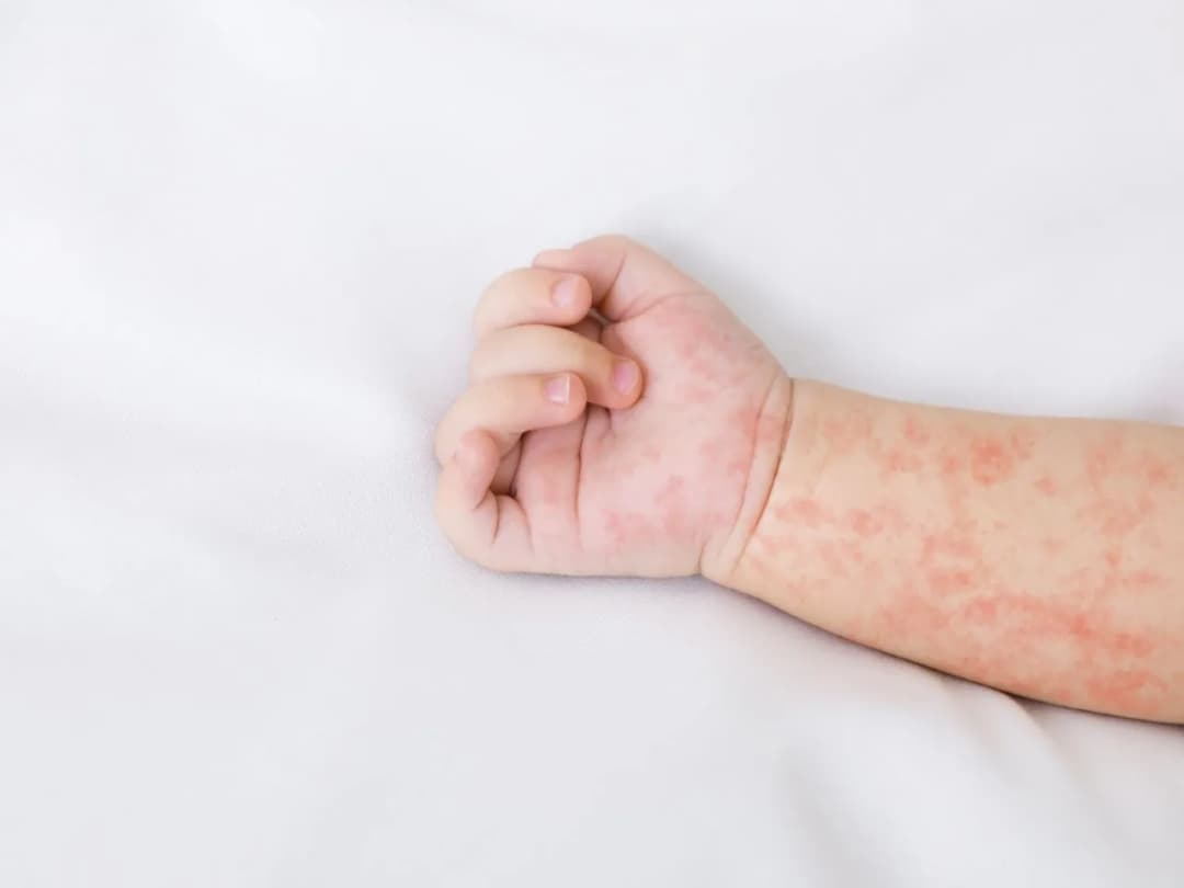 Jak wygląda uczulenie na proszek u niemowlaka? Objawy i rady